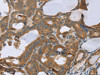 The image on the left is immunohistochemistry of paraffin-embedded Human thyroid cancer tissue using CSB-PA940611 (SLC39A7 Antibody) at dilution 1/40, on the right is treated with synthetic peptide. (Original magnification: ×200)