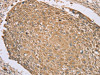 The image on the left is immunohistochemistry of paraffin-embedded Human lung cancer tissue using CSB-PA265607 (RNF148 Antibody) at dilution 1/45, on the right is treated with synthetic peptide. (Original magnification: ×200)