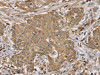 The image on the left is immunohistochemistry of paraffin-embedded Human cervical cancer tissue using CSB-PA265607 (RNF148 Antibody) at dilution 1/45, on the right is treated with synthetic peptide. (Original magnification: ×200)