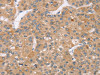 The image on the left is immunohistochemistry of paraffin-embedded Human liver cancer tissue using CSB-PA162126 (TRIM34 Antibody) at dilution 1/35, on the right is treated with synthetic peptide. (Original magnification: ×200)