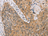 The image on the left is immunohistochemistry of paraffin-embedded Human esophagus cancer tissue using CSB-PA162126 (TRIM34 Antibody) at dilution 1/35, on the right is treated with synthetic peptide. (Original magnification: ×200)