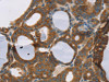 The image on the left is immunohistochemistry of paraffin-embedded Human thyroid cancer tissue using CSB-PA981363 (RORB Antibody) at dilution 1/30, on the right is treated with synthetic peptide. (Original magnification: ×200)