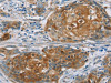 The image on the left is immunohistochemistry of paraffin-embedded Human cervical cancer tissue using CSB-PA981363 (RORB Antibody) at dilution 1/30, on the right is treated with synthetic peptide. (Original magnification: ×200)