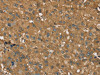 The image on the left is immunohistochemistry of paraffin-embedded Human liver cancer tissue using CSB-PA779062 (RORB Antibody) at dilution 1/35, on the right is treated with synthetic peptide. (Original magnification: ×200)