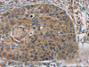 The image on the left is immunohistochemistry of paraffin-embedded Human esophagus cancer tissue using CSB-PA779062 (RORB Antibody) at dilution 1/35, on the right is treated with synthetic peptide. (Original magnification: ×200)