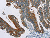 The image on the left is immunohistochemistry of paraffin-embedded Human colon cancer tissue using CSB-PA035961 (RPS6KA2 Antibody) at dilution 1/20, on the right is treated with synthetic peptide. (Original magnification: ×200)