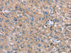 The image on the left is immunohistochemistry of paraffin-embedded Human liver cancer tissue using CSB-PA698102 (SAMD9 Antibody) at dilution 1/35, on the right is treated with synthetic peptide. (Original magnification: ×200)