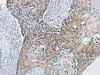 The image on the left is immunohistochemistry of paraffin-embedded Human esophagus cancer tissue using CSB-PA170230 (SCD Antibody) at dilution 1/20, on the right is treated with synthetic peptide. (Original magnification: ×200)
