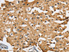 The image on the left is immunohistochemistry of paraffin-embedded Human prostate cancer tissue using CSB-PA091643 (SEC14L2 Antibody) at dilution 1/25, on the right is treated with synthetic peptide. (Original magnification: ×200)