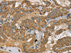 The image on the left is immunohistochemistry of paraffin-embedded Human thyroid cancer tissue using CSB-PA091643 (SEC14L2 Antibody) at dilution 1/25, on the right is treated with synthetic peptide. (Original magnification: ×200)