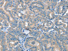 The image on the left is immunohistochemistry of paraffin-embedded Human thyroid cancer tissue using CSB-PA183005 (SEPN1 Antibody) at dilution 1/20, on the right is treated with synthetic peptide. (Original magnification: ×200)