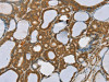 The image on the left is immunohistochemistry of paraffin-embedded Human thyroid cancer tissue using CSB-PA215833 (SENP1 Antibody) at dilution 1/35, on the right is treated with synthetic peptide. (Original magnification: ×200)