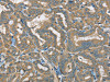 The image on the left is immunohistochemistry of paraffin-embedded Human thyroid cancer tissue using CSB-PA985822 (ATP2A3 Antibody) at dilution 1/30, on the right is treated with synthetic peptide. (Original magnification: ×200)