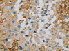 The image on the left is immunohistochemistry of paraffin-embedded Human prostate cancer tissue using CSB-PA715783 (SERINC1 Antibody) at dilution 1/40, on the right is treated with synthetic peptide. (Original magnification: ×200)
