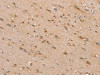 The image on the left is immunohistochemistry of paraffin-embedded Human brain tissue using CSB-PA251777 (SLC25A20 Antibody) at dilution 1/30, on the right is treated with synthetic peptide. (Original magnification: ×200)