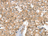 The image on the left is immunohistochemistry of paraffin-embedded Human breast cancer tissue using CSB-PA577390 (SLC6A7 Antibody) at dilution 1/30, on the right is treated with synthetic peptide. (Original magnification: ×200)