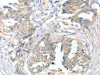 The image on the left is immunohistochemistry of paraffin-embedded Human cervical cancer tissue using CSB-PA140998 (SLC9A9 Antibody) at dilution 1/45, on the right is treated with synthetic peptide. (Original magnification: ×200)