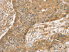 The image on the left is immunohistochemistry of paraffin-embedded Human esophagus cancer tissue using CSB-PA258249 (SLIT1 Antibody) at dilution 1/35, on the right is treated with synthetic peptide. (Original magnification: ×200)
