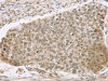 The image on the left is immunohistochemistry of paraffin-embedded Human esophagus cancer tissue using CSB-PA822578 (SMARCA2 Antibody) at dilution 1/25, on the right is treated with synthetic peptide. (Original magnification: ×200)