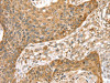 The image on the left is immunohistochemistry of paraffin-embedded Human esophagus cancer tissue using CSB-PA174716 (SMC4 Antibody) at dilution 1/35, on the right is treated with synthetic peptide. (Original magnification: ×200) The image on the left is immunohistochemistry of paraffin-embedded Human esophagus cancer tissue using CSB-PA174716 (SMC4 Antibody) at dilution 1/35, on the right is treated with synthetic peptide. (Original magnification: ×200)