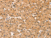 The image on the left is immunohistochemistry of paraffin-embedded Human liver cancer tissue using CSB-PA991288 (SNX30 Antibody) at dilution 1/35, on the right is treated with synthetic peptide. (Original magnification: ×200)