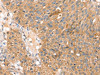 The image on the left is immunohistochemistry of paraffin-embedded Human breast cancer tissue using CSB-PA899716 (SOX11 Antibody) at dilution 1/20, on the right is treated with synthetic peptide. (Original magnification: ×200)