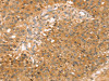 The image on the left is immunohistochemistry of paraffin-embedded Human breast cancer tissue using CSB-PA657438 (SOX11 Antibody) at dilution 1/20, on the right is treated with synthetic peptide. (Original magnification: ×200)