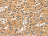 The image on the left is immunohistochemistry of paraffin-embedded Human liver cancer tissue using CSB-PA308950 (SPATA18 Antibody) at dilution 1/20, on the right is treated with synthetic peptide. (Original magnification: ×200)