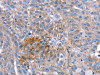The image on the left is immunohistochemistry of paraffin-embedded Human breast cancer tissue using CSB-PA729987 (SPATA5L1 Antibody) at dilution 1/20, on the right is treated with synthetic peptide. (Original magnification: ×200)