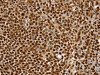 The image on the left is immunohistochemistry of paraffin-embedded Human ovarian cancer tissue using CSB-PA127171 (SSB Antibody) at dilution 1/30, on the right is treated with synthetic peptide. (Original magnification: ×200)