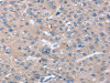 The image on the left is immunohistochemistry of paraffin-embedded Human liver cancer tissue using CSB-PA065668 (STK36 Antibody) at dilution 1/20, on the right is treated with synthetic peptide. (Original magnification: ×200)