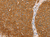 The image on the left is immunohistochemistry of paraffin-embedded Human breast cancer tissue using CSB-PA590986 (ABCC8 Antibody) at dilution 1/40, on the right is treated with synthetic peptide. (Original magnification: ×200)