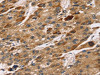 The image on the left is immunohistochemistry of paraffin-embedded Human liver cancer tissue using CSB-PA982780 (TM4SF1 Antibody) at dilution 1/30, on the right is treated with synthetic peptide. (Original magnification: ×200)