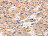 The image on the left is immunohistochemistry of paraffin-embedded Human liver cancer tissue using CSB-PA088613 (TAP2 Antibody) at dilution 1/30, on the right is treated with synthetic peptide. (Original magnification: ×200)