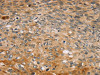 The image on the left is immunohistochemistry of paraffin-embedded Human esophagus cancer tissue using CSB-PA842369 (TBC1D21 Antibody) at dilution 1/30, on the right is treated with synthetic peptide. (Original magnification: ×200)