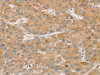 The image on the left is immunohistochemistry of paraffin-embedded Human liver cancer tissue using CSB-PA842369 (TBC1D21 Antibody) at dilution 1/30, on the right is treated with synthetic peptide. (Original magnification: ×200)