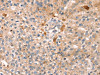 The image on the left is immunohistochemistry of paraffin-embedded Human breast cancer tissue using CSB-PA161763 (THAP9 Antibody) at dilution 1/20, on the right is treated with synthetic peptide. (Original magnification: ×200)
