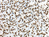 The image on the left is immunohistochemistry of paraffin-embedded Human liver cancer tissue using CSB-PA133989 (TRIM27 Antibody) at dilution 1/35, on the right is treated with synthetic peptide. (Original magnification: ×200)