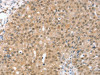 The image on the left is immunohistochemistry of paraffin-embedded Human breast cancer tissue using CSB-PA192313 (TRIM35 Antibody) at dilution 1/35, on the right is treated with synthetic peptide. (Original magnification: ×200)
