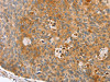 The image on the left is immunohistochemistry of paraffin-embedded Human esophagus cancer tissue using CSB-PA988387 (ZFP36L2 Antibody) at dilution 1/45, on the right is treated with synthetic peptide. (Original magnification: ×200)