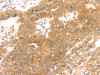 The image on the left is immunohistochemistry of paraffin-embedded Human breast cancer tissue using CSB-PA928507 (TMEFF2 Antibody) at dilution 1/35, on the right is treated with synthetic peptide. (Original magnification: ×200)