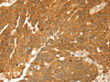 The image on the left is immunohistochemistry of paraffin-embedded Human breast cancer tissue using CSB-PA451608 (TMEFF2 Antibody) at dilution 1/35, on the right is treated with synthetic peptide. (Original magnification: ×200)