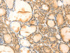 The image on the left is immunohistochemistry of paraffin-embedded Human thyroid cancer tissue using CSB-PA292260 (VMP1 Antibody) at dilution 1/35, on the right is treated with synthetic peptide. (Original magnification: ×200)