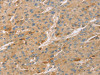 The image on the left is immunohistochemistry of paraffin-embedded Human liver cancer tissue using CSB-PA599200 (TNFSF13 Antibody) at dilution 1/20, on the right is treated with synthetic peptide. (Original magnification: ×200)