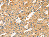 The image on the left is immunohistochemistry of paraffin-embedded Human liver cancer tissue using CSB-PA577745 (TNFSF15 Antibody) at dilution 1/30, on the right is treated with synthetic peptide. (Original magnification: ×200)