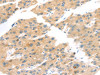 The image on the left is immunohistochemistry of paraffin-embedded Human liver cancer tissue using CSB-PA046438 (TNK1 Antibody) at dilution 1/20, on the right is treated with synthetic peptide. (Original magnification: ×200)