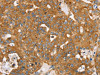 The image on the left is immunohistochemistry of paraffin-embedded Human breast cancer tissue using CSB-PA186945 (TPD52L2 Antibody) at dilution 1/20, on the right is treated with synthetic peptide. (Original magnification: ×200)