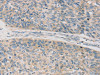 The image on the left is immunohistochemistry of paraffin-embedded Human esophagus cancer tissue using CSB-PA917997 (TPH2 Antibody) at dilution 1/20, on the right is treated with synthetic peptide. (Original magnification: ×200)