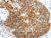 The image on the left is immunohistochemistry of paraffin-embedded Human esophagus cancer tissue using CSB-PA890141 (HUNK Antibody) at dilution 1/35, on the right is treated with synthetic peptide. (Original magnification: ×200)