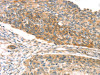 The image on the left is immunohistochemistry of paraffin-embedded Human esophagus cancer tissue using CSB-PA778095 (TPST1 Antibody) at dilution 1/20, on the right is treated with synthetic peptide. (Original magnification: ×200)